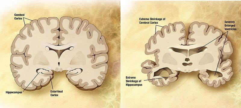 Guest Post: B Vitamins May Decrease the Risk of Alzheimer's Disease